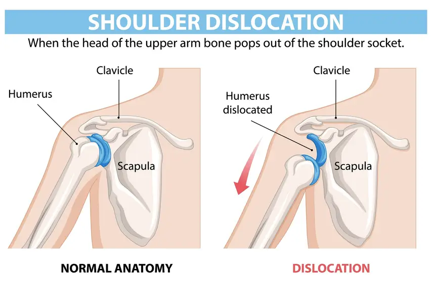 Dislocations